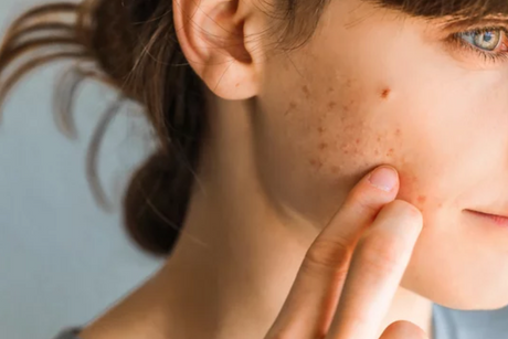 SOP y acné, exceso de vello o caída de cabello: ¿qué significa el exceso de andrógenos?