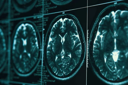 🧠 Creatina y Alzheimer: ¿Una nueva esperanza para la salud cerebral?